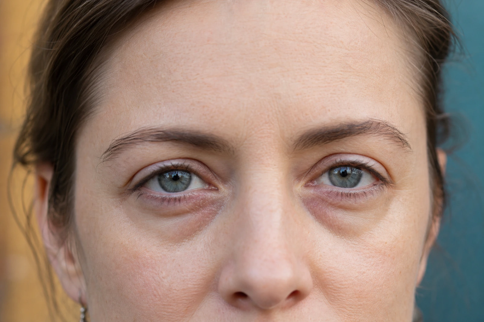 close-up oogpartij met wallen en donkere kringen